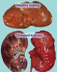 Healthy Kidney and Diseased Kidneys
